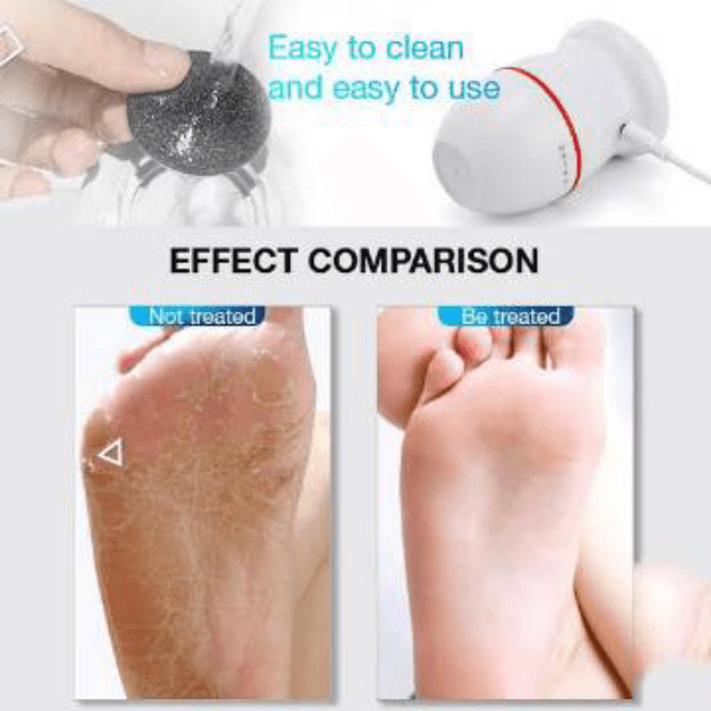 Electric Foot Grinder: Portable Foot File